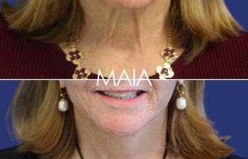 64 year-old patient before after facelift, neck lift, lower and upper blepharoplasty, canthopexy, CO2 laser