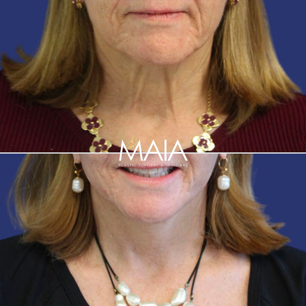 64 year-old patient before after facelift, neck lift, lower and upper blepharoplasty, canthopexy, CO2 laser