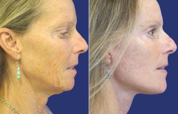 59 year-old - facelift, neck lift, upper blepharoplasty, brow lift, facial fat grafting , TCA Peel and skincare treatment
