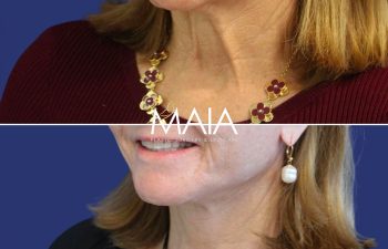 64 year-old patient before after facelift, neck lift, lower and upper blepharoplasty, canthopexy, CO2 laser