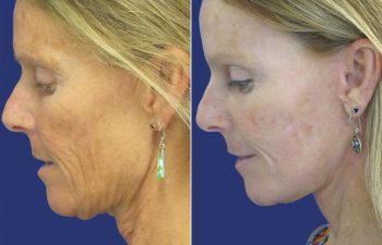 59 year-old - facelift, neck lift, upper blepharoplasty, brow lift, facial fat grafting , TCA Peel and skincare treatment