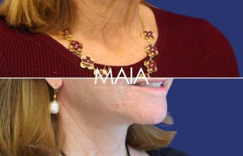 64 year-old patient before after facelift, neck lift, lower and upper blepharoplasty, canthopexy, CO2 laser