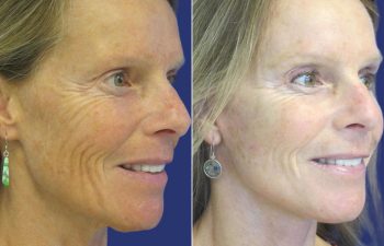 59 year-old - facelift, neck lift, upper blepharoplasty, brow lift, facial fat grafting , TCA Peel and skincare treatment