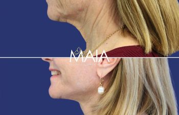 64 year-old patient before after facelift, neck lift, lower and upper blepharoplasty, canthopexy, CO2 laser