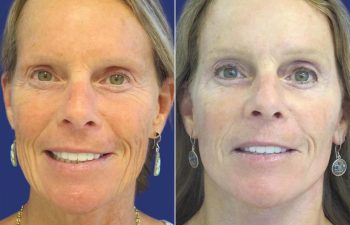 59 year-old - facelift, neck lift, upper blepharoplasty, brow lift, facial fat grafting , TCA Peel and skincare treatment