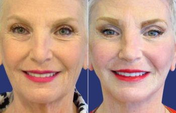 Female Patient Before & After FaceLift