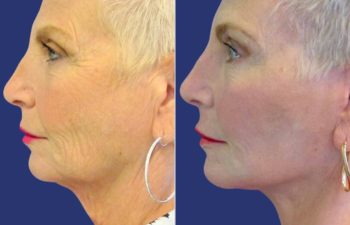 Female Patient Before & After FaceLift