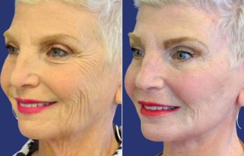 Female Patient Before & After FaceLift