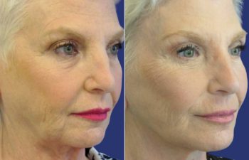 Female Patient Before & After FaceLift