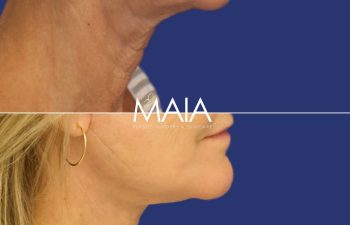 61 year-old patient before and after Mini-facelift, Neck lift, CO2 laser