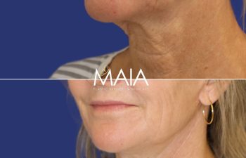 61 year-old patient before and after Mini-facelift, Neck lift, CO2 laser