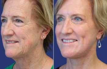 Female Patient Before & After FaceLift