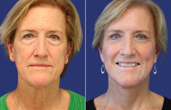 Female Patient Before & After FaceLift