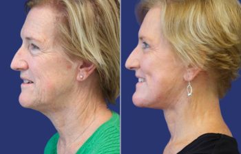 Female Patient Before & After FaceLift