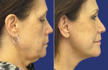 65 year-old facelift, neck lift, lower blepharoplasty, facial fat grafting, TCA Peel and skincare treatment