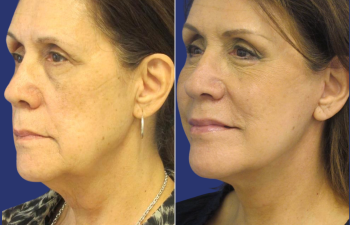 65 year-old facelift, neck lift, lower blepharoplasty, facial fat grafting, TCA Peel and skincare treatment