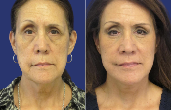 65 year-old facelift, neck lift, lower blepharoplasty, facial fat grafting, TCA Peel and skincare treatment