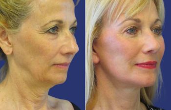 Female Patient Before & After FaceLift