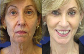 Female Patient Before & After FaceLift