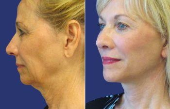 Female Patient Before & After FaceLift