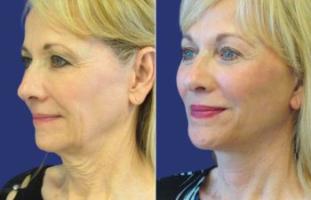Female Patient Before & After FaceLift