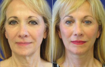 Female Patient Before & After FaceLift