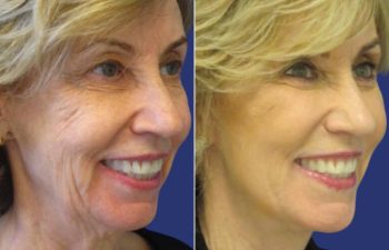 Female Patient Before & After FaceLift