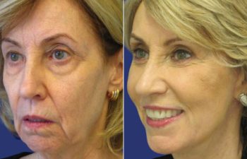Female Patient Before & After FaceLift