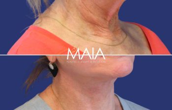 Female Patient Before & After FaceLift and Neck Lift