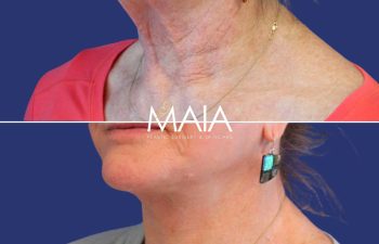 Female Patient Before & After FaceLift and Neck Lift