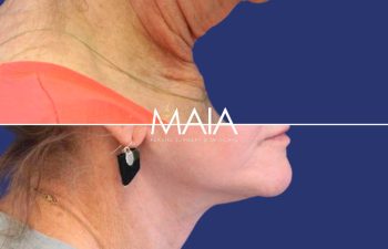Female Patient Before & After FaceLift and Neck Lift