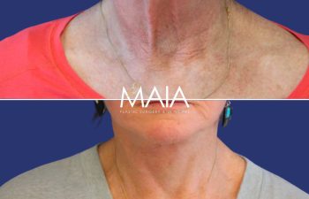Female Patient Before & After FaceLift and Neck Lift