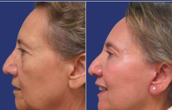 Patient before and after a facelift, neck lift, upper blepharoplasty, fat grafting to the face, and a TCA peel