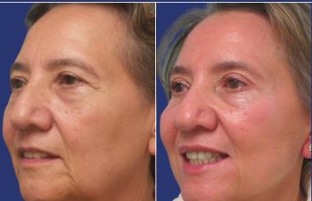 Patient before and after a facelift, neck lift, upper blepharoplasty, fat grafting to the face, and a TCA peel