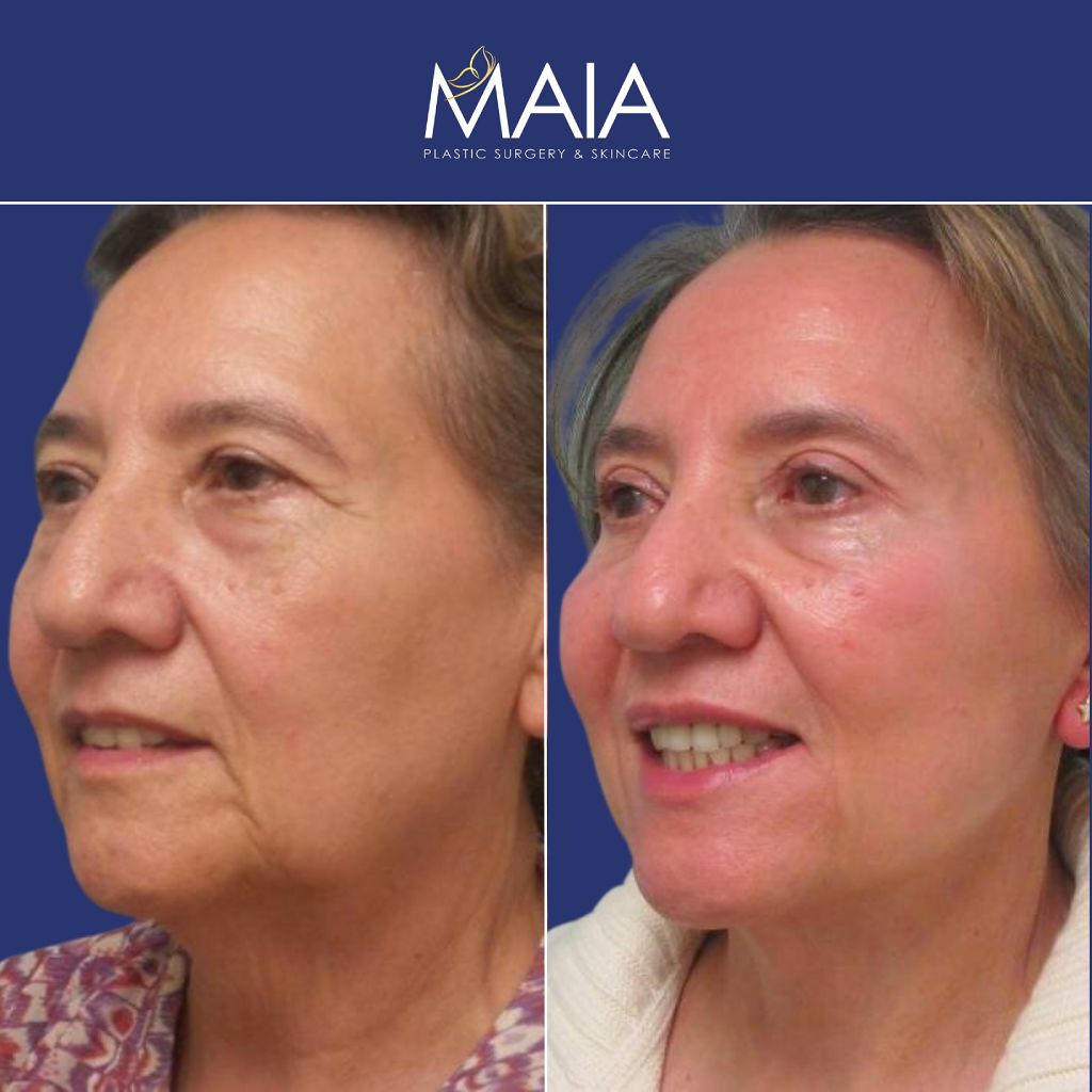 Patient before and after a facelift, neck lift, upper blepharoplasty, fat grafting to the face, and a TCA peel