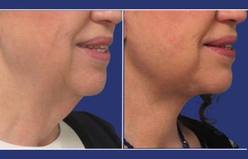 patient before and after a facelift and neck lift