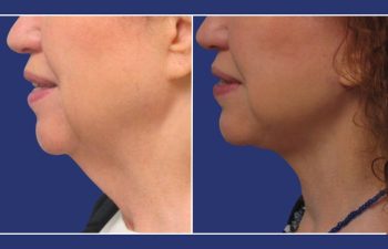 Patient before and after facelift and neck lift