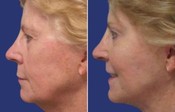 Female Patient Before & After FaceLift
