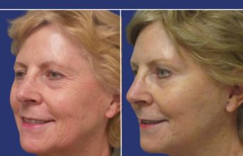 Female Patient Before & After FaceLift