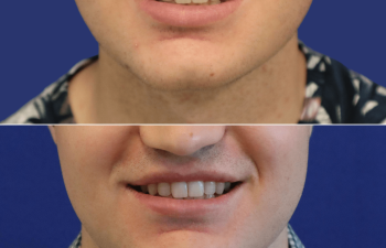 male before and after lip reduction