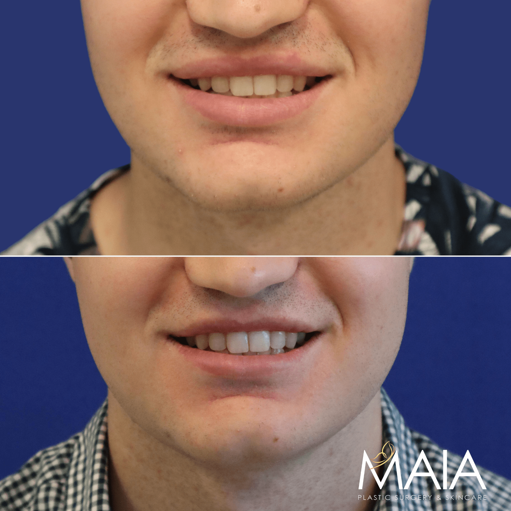 male before and after lip reduction