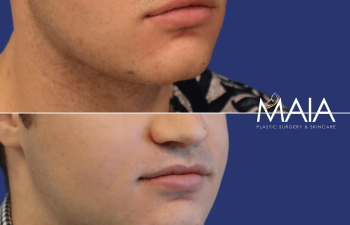 male before and after lip reduction