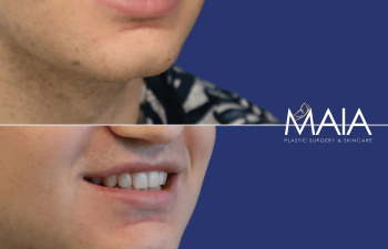 male before and after lip reduction