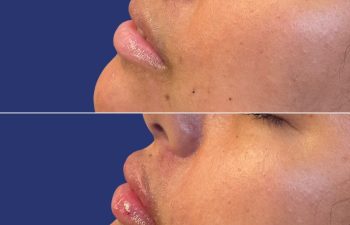 before and after Lip Filler