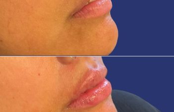 before and after Lip Filler
