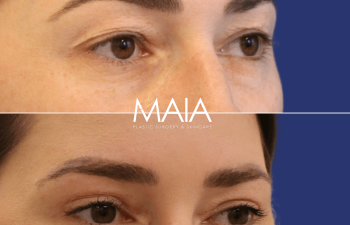 30 year-old patient before and 5 months after upper blepharoplasty