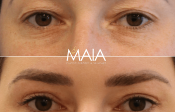 30 year-old patient before and 5 months after upper blepharoplasty