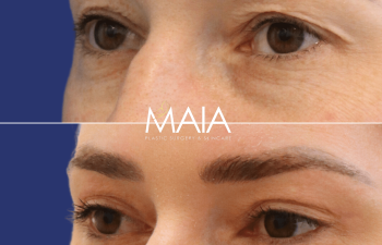 30 year-old patient before and 5 months after upper blepharoplasty