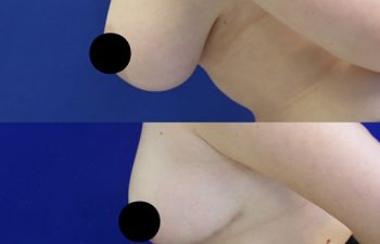 31 year-old female patient 2 months after breast reduction