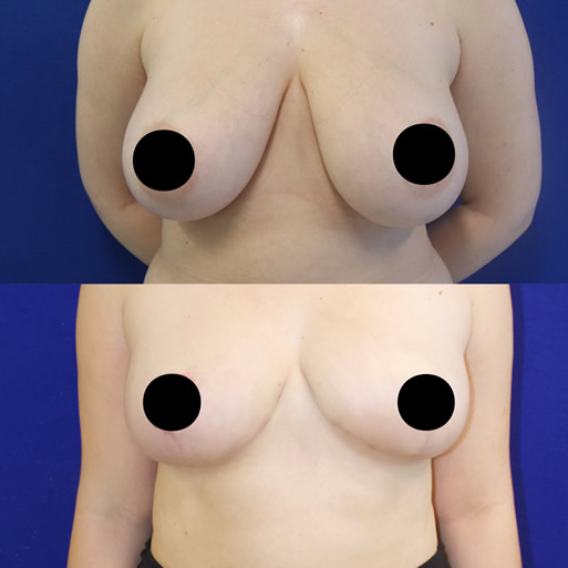 31 year-old female patient 2 months after breast reduction